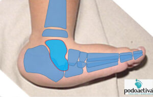 pie en balancín o astrágalo vertical congénito aislado (AVC)