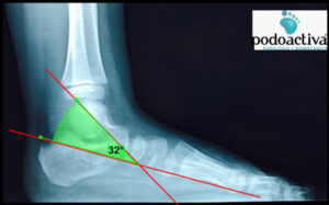 pie en balancín o astrágalo vertical congénito aislado (AVC)
