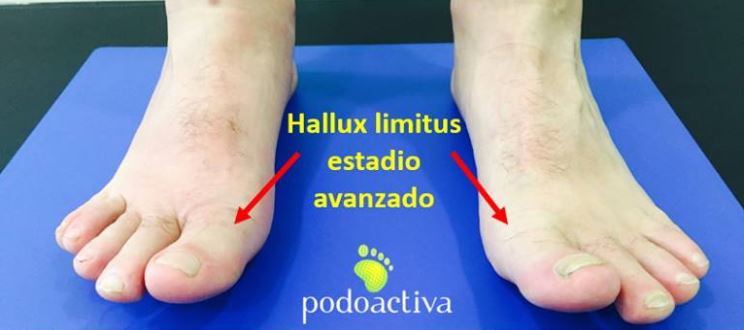 hallux_limitus_podoactiva_podologia_recortada