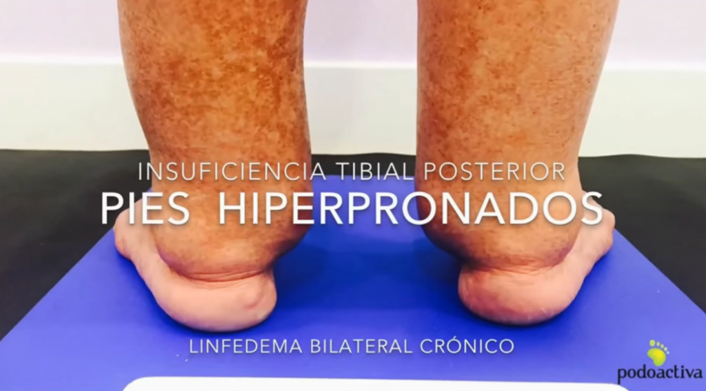 insuficiencia_tibial_posterior_podoactiva