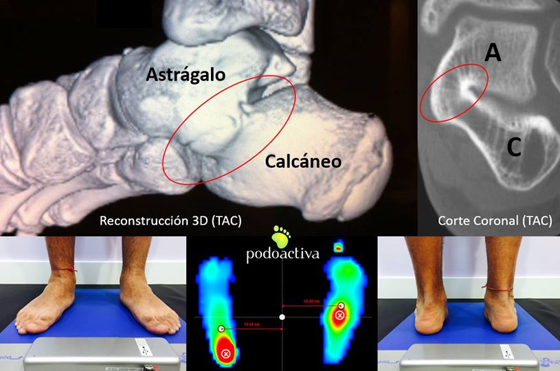 coalicion_tarsal