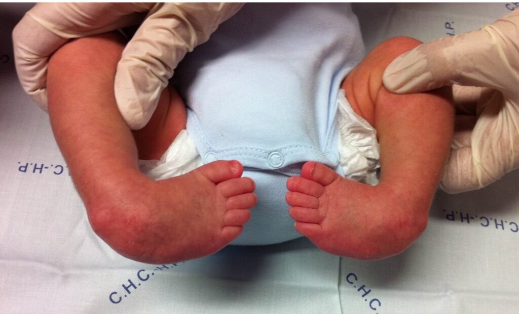 Pie zambo o equinovaro. Qué es y cómo tratarlo