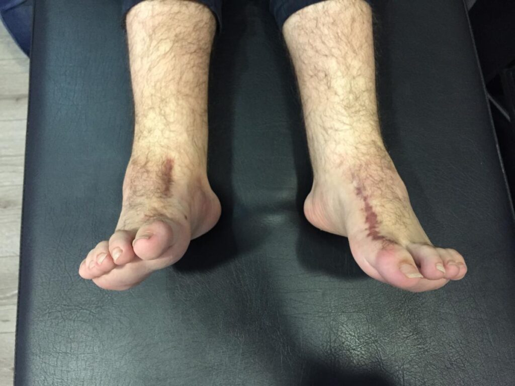 Pie zambo o equinovaro. Qué es y cómo tratarlo