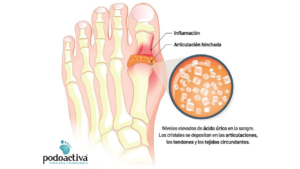 enfermedad de la gota