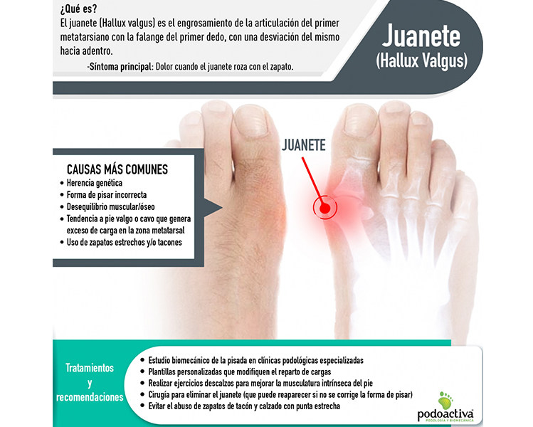 Infographic about bunions from Podoactiva
