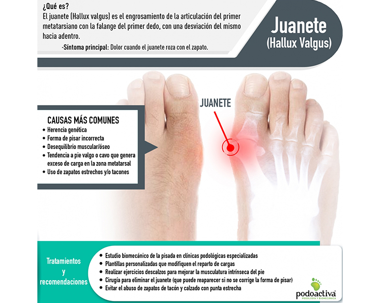 Infografía sobre juanetes de Podoactiva