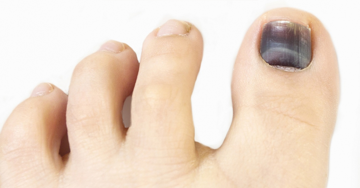 Gladys Otoño Haz un esfuerzo Uña negra en el pie. Causas, tratamiento y prevención - Podoactiva. Líderes en Podología Gladys Otoño Haz un esfuerzo Uña negra en el pie. Causas, tratamiento y prevención - Podoactiva. Líderes en Podología