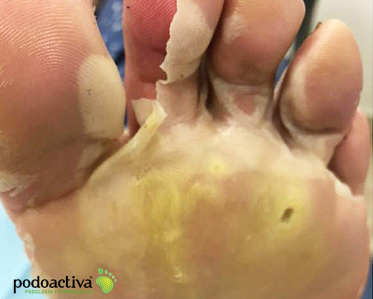 sole of the foot with yellowish skin due to the use of callicides