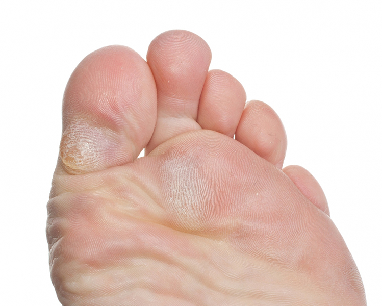calluses on the bottom of the foot and behind the big toe