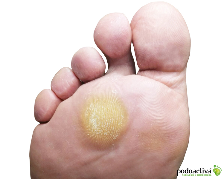 dureza de color amarillento en la zona de debajo de los dedos del pie
