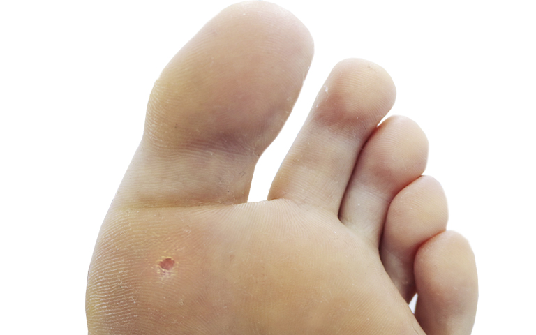 probable La ciudad Odia Callos en los pies o callosidades. Cómo tratarlos y cómo prevenirlos