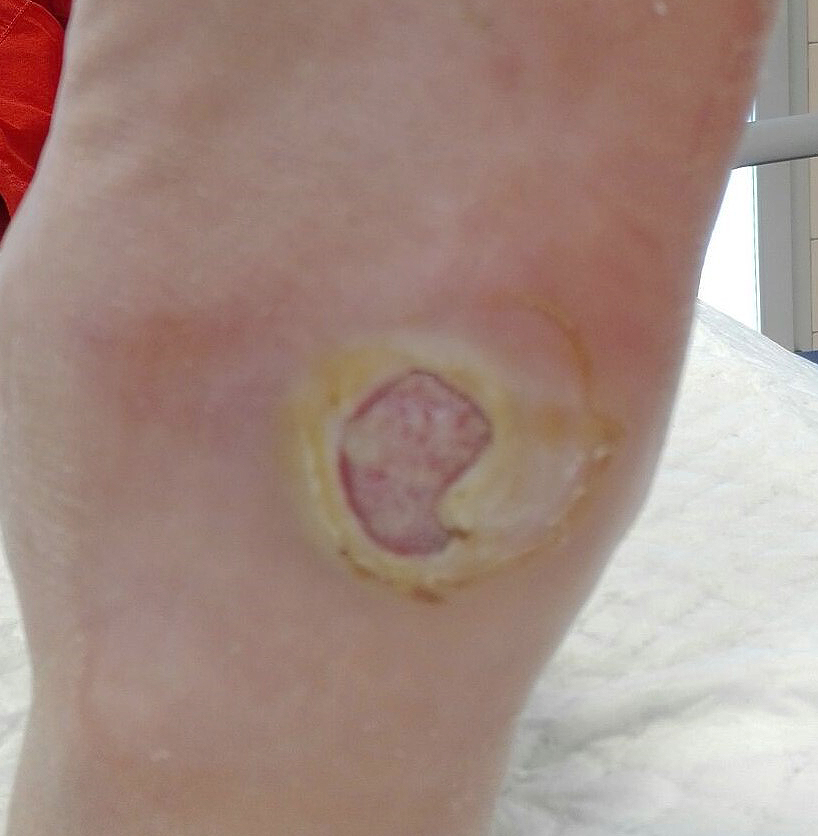 úlcera de pie diabético en el pie izquierdo