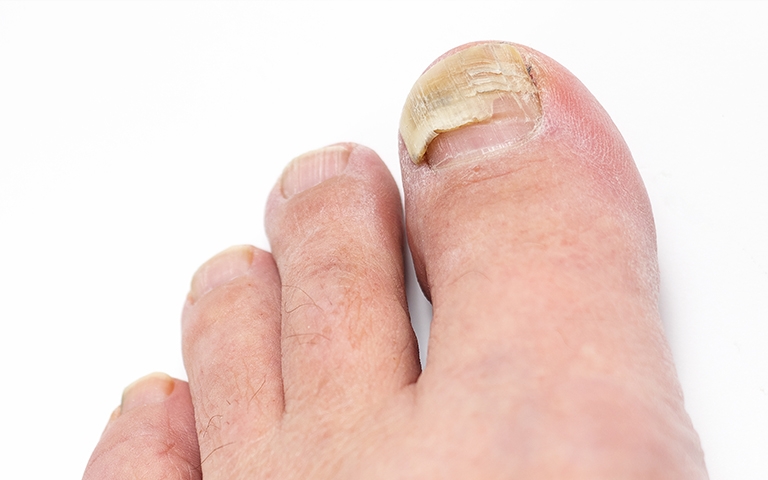 Por qué se ponen las uñas de los pies negras  Fisioterapia Eva Tello  Cadarso