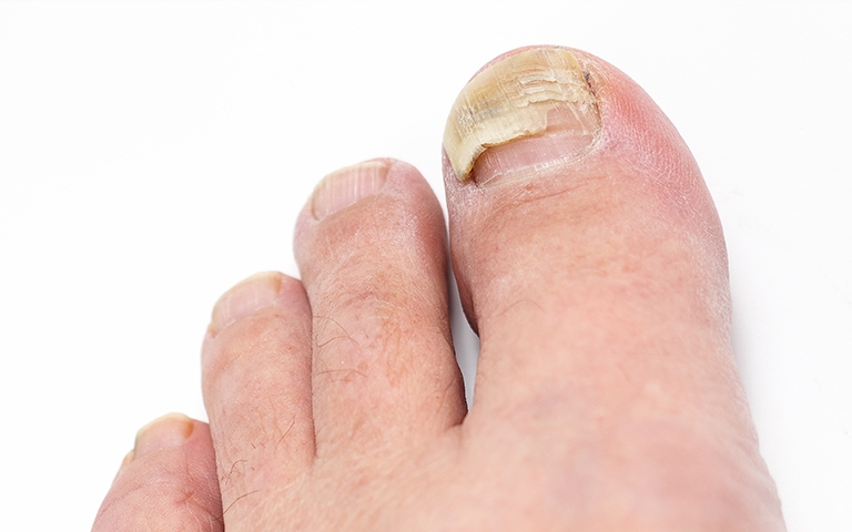 bomba Escabullirse Ser amado Crecimiento de las uñas de los pies. ¿Cuándo, cuánto y por qué crecen? - Podoactiva. Líderes en Podología bomba Escabullirse Ser amado Crecimiento de las uñas de los pies. ¿Cuándo, cuánto y por qué crecen? - Podoactiva. Líderes en Podología