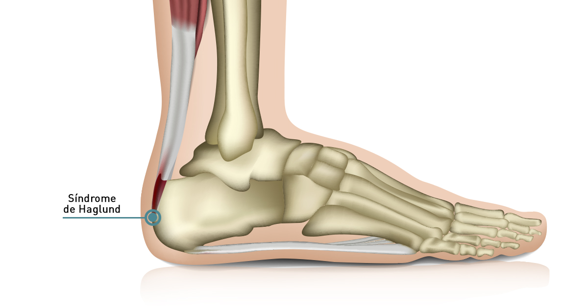 Sindrome de Haglund o prominencia osea en el talon Podoactiva. Podologia y biomecanica