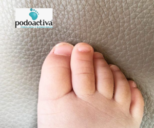 pie niño clinodactilia o dedos torcidos