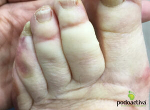 enfermedad raynaud