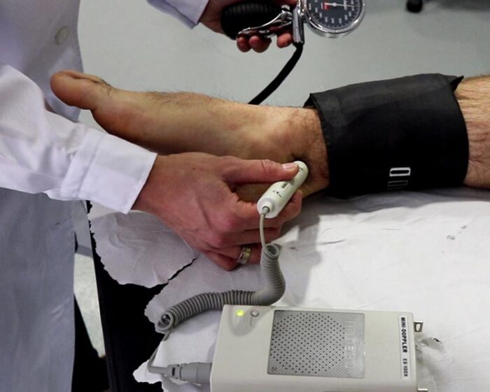 Pie diabético. Consejos y tratamientos para prevenir úlceras en los pies