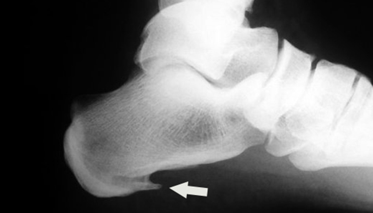 X-ray of the calcaneal spur of Podoactiva