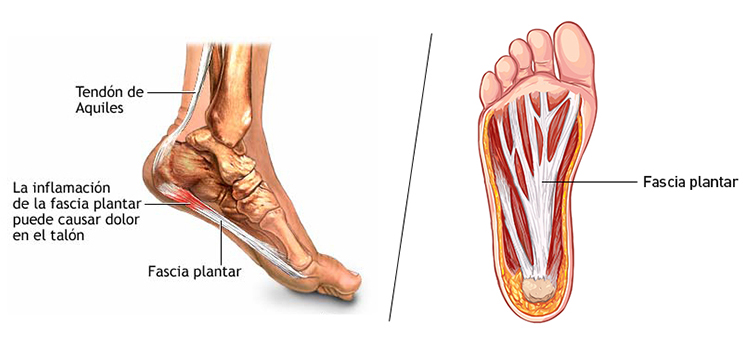 Partes del pie con la inflamación de la fascia plantar
