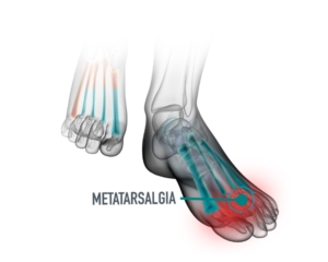 MEtatarsalgia