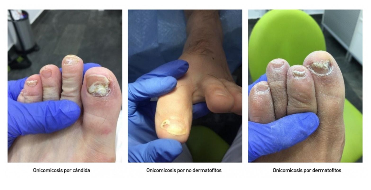 Onicomicosis por candida, por dermatofitos, por no dermatorfitos