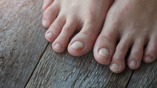 Onicomicosis-hongo en la uña del pie