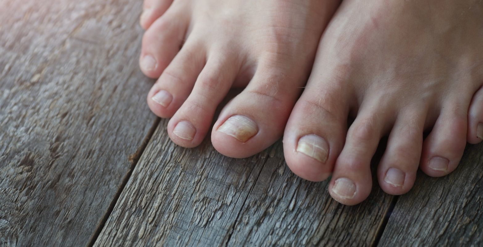 onicomicosis-hongo en la uña del pie