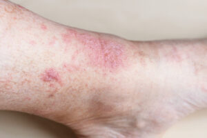 eccema dermatitis