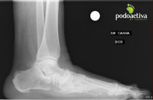 radiografía ligamento_de_spring