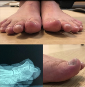 operacion dedo gordo del pie