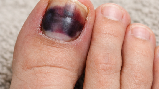 uña negra del pie