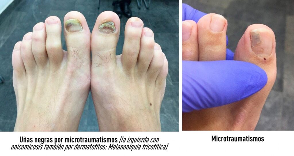 uñas negras por microtraumatismos
