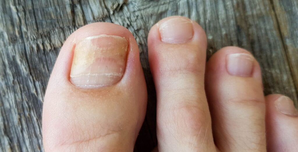 uña encarnada - caso clinico