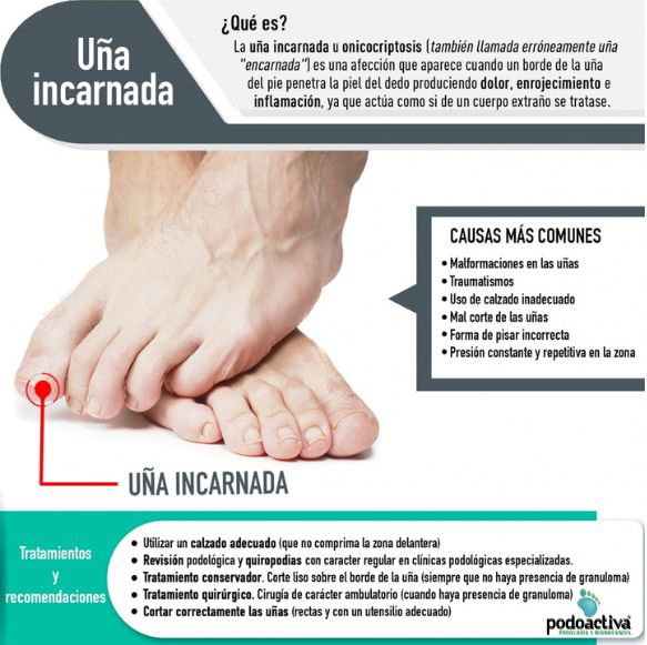 uña incarnada que es, causasy tratamiento