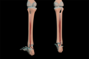 tibial posterior