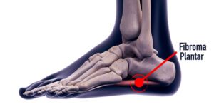 fibroma plantar