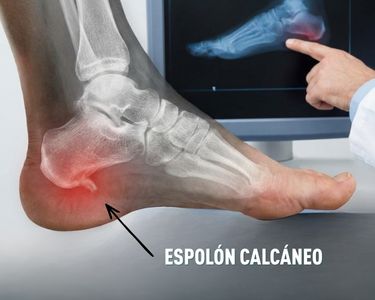 Espolon calcaneo. Dolor en el talón