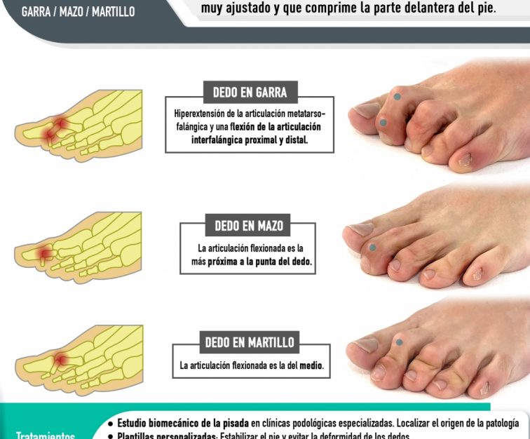Dedos torcidos o desviados en los pies o clinodactilia. Síntomas