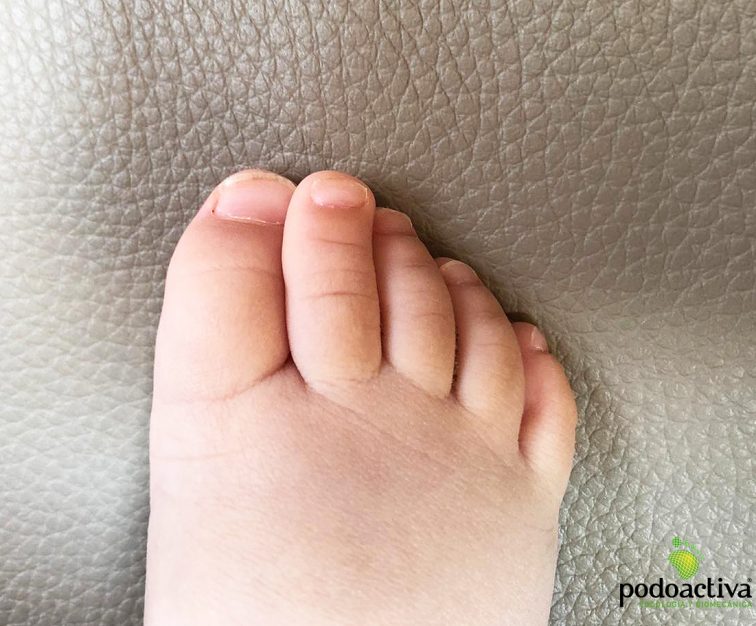 Dedos torcidos o desviados en los pies o clinodactilia. Síntomas