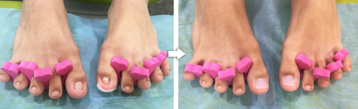 Problemas más comunes en las uñas de los pies. Causas y tratamientos Podoactiva. Líderes Podología