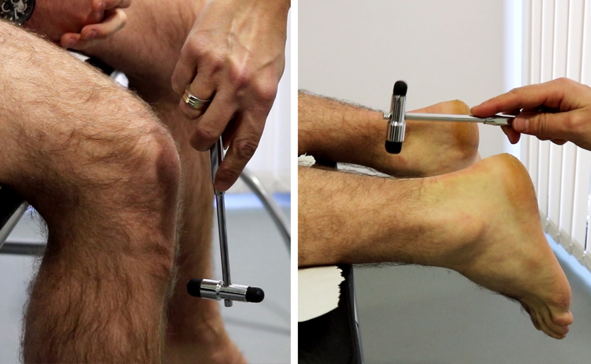Exploración de los reflejos (rotuliano y Aquileo) del pie diabético