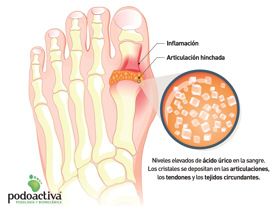 Inflamacion de una articulacion