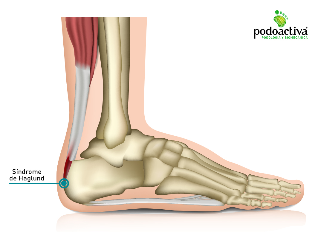 Fascitis plantar, espolones y edema óseo: ¿Cómo aliviar el dolor?