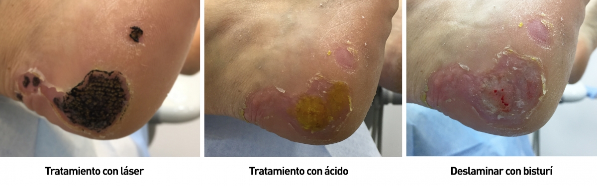 Example of various types of treatment to cure plantar warts