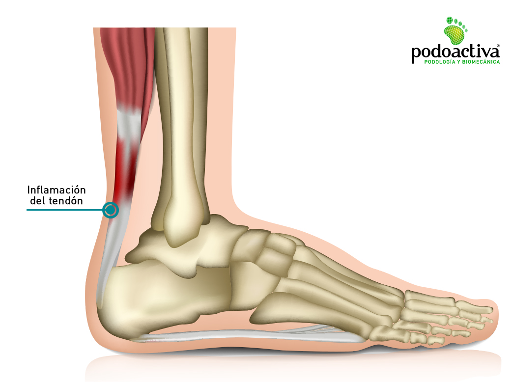 Rotura del tendón de Aquiles y tendinopatías Síntomas, causas y tratamientos Rotura del tendón de Aquiles y tendinopatías Síntomas, causas y tratamientos