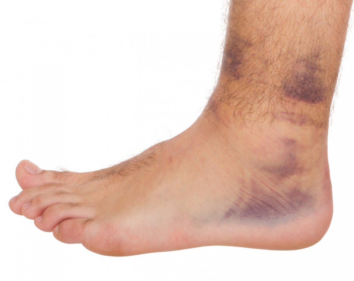Esguince de tobillo. Síntomas, causas y tratamientos esta lesión pie