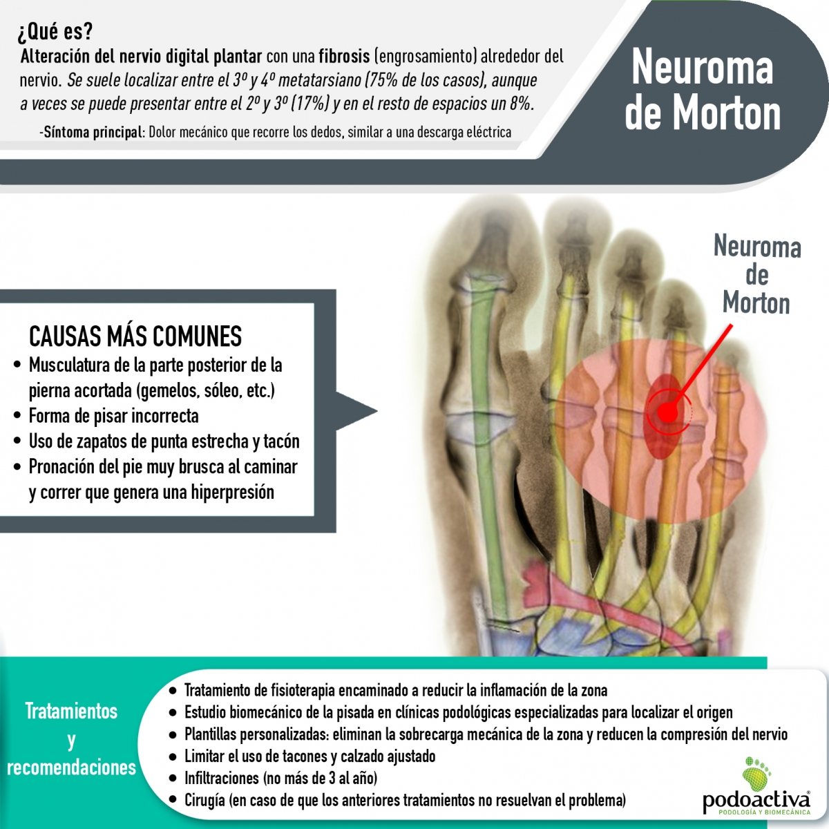 ¿Qué es el neuroma de morton?