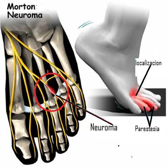 El neuroma de Morton es una degeneración del nervio digital plantar acompañada de una fibrosis.