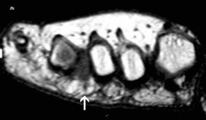 ¿CÓMO SE DIAGNÓSTICA EL NEUROMA DE MORTON?